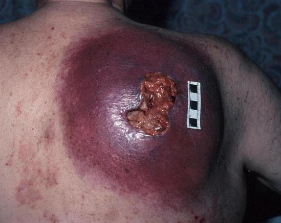 fig-1-melanoma-back